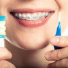 Ce trebuie să știi despre aparatele dentare pentru un zâmbet încrezător 