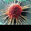 O nouă terapie contra cancerelor pancreasului și colonului