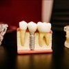 Implant Studio – locul unde orice problemă dentară are o soluție