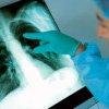 Creșterea alarmantă a cazurilor de tuberculoză în Anglia sub investigație
