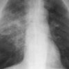 O treime din pacienţii diagnosticaţi cu pneumonii în ultima săptămână au fost internaţi