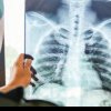 Medic: Aerul curat, soluţia pentru un plămân sănătos/ Cancerul pulmonar, cu cea mai mare mortalitate