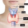 Bolile tiroidiene sunt boli frecvente la doamne. România este o ţară deficitară în iod, motiv pentru care guşa este o boală naţională