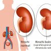Ziua Mondială a Rinichiului: 1 din 10 români trăieşte cu boală cronică de rinichi