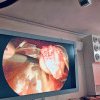 Operație în premieră la spitalul Roman: prima intervenție laparoscopică pentru cancer la rinichi, cu păstrarea organului, efectuată în afara unui centru universitar