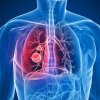O terapie nouă contra cancerului pulmonar, aprobată în SUA