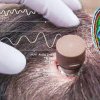 VIDEO Implantul Neuralink funcționează: Un pacient paralizat de la gât în jos poate controla un calculator doar cu ajutorul cipului implantat în creier