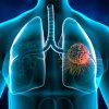 A apărut leacul pentru cancerul pulmonar: SUA au aprobat tratamentul