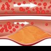 Elimină colesterolul rău - Şase alimente care curăţă vasele de sânge