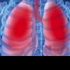 Olt: Cazurile de gripă şi infecţii respiratorii acute, în scădere faţă de luna februarie