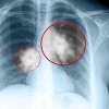 Creşterea alarmantă a numărului de cazuri de cancer pulmonar la nefumători, legată de prezenţa unui gaz radioactiv din aer
