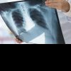 O nouă cauză a leziunilor pulmonare descoperită de oameni de știință
