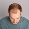 Alopecia – factori de risc, cauze și tratament. De ce chelesc bărbații