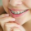 Tipuri de aparate dentare și beneficiile acestora