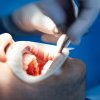 Implantul dentar vs proteza dentară. TOT ce trebuie să știi pentru a face cea mai bună alegere
