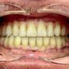 Totul despre dinți  ficși în 24 de ore cu Dr. Grigori Vartolomei