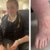 Provocarea virală pe TikTok a lăsat o fată de 12 ani cu arsuri severe, după ce a amestecat apă cu zahăr