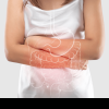 BOLI INFLAMATORII Crește incidența bolilor inflamatorii intestinale